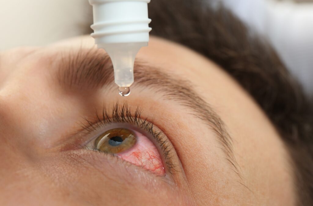 A close-up of a person using eye drops on an inflamed eye to find relief from pink eye symptoms.