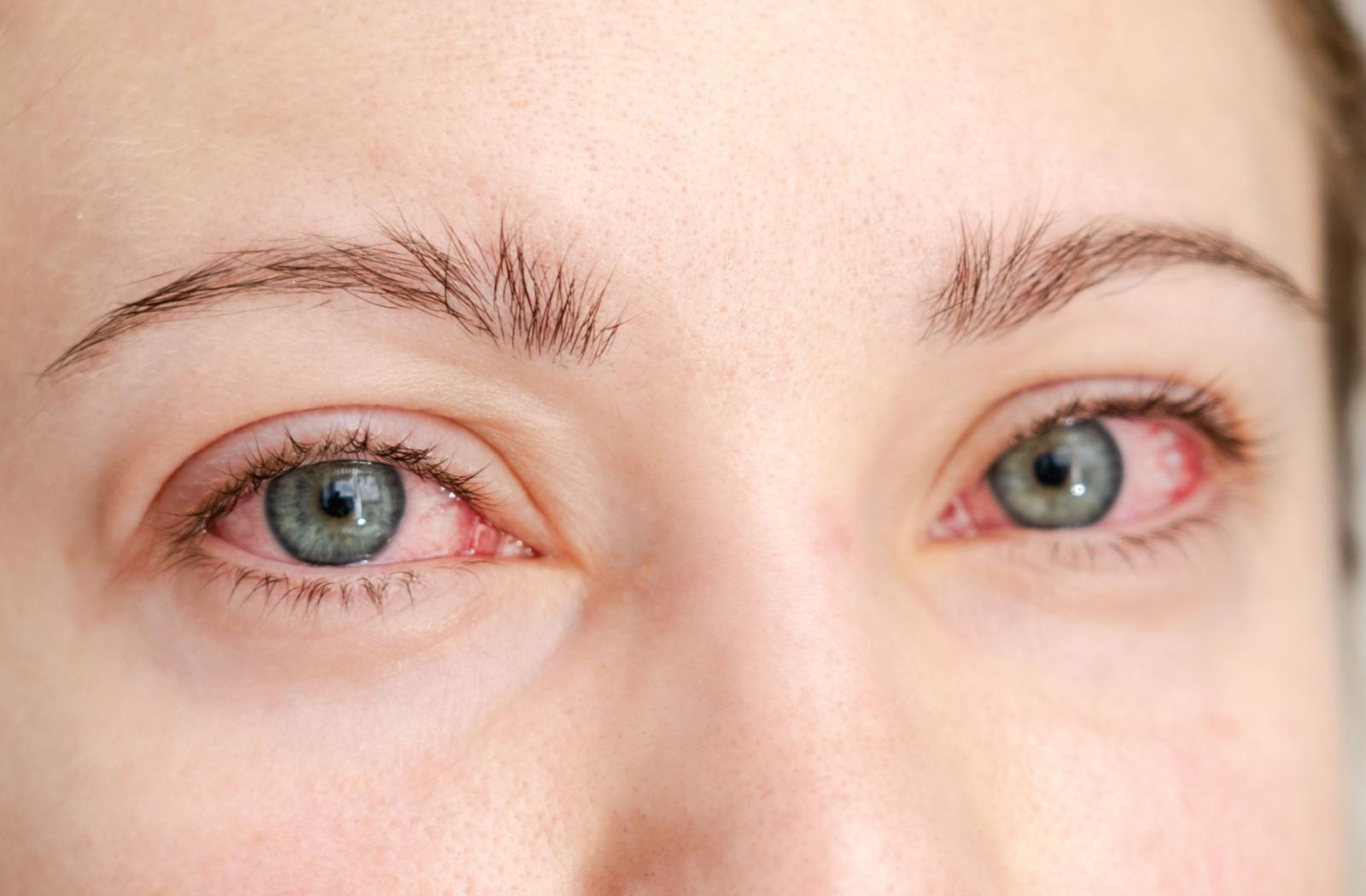 A close up of red, irritated eyes.
